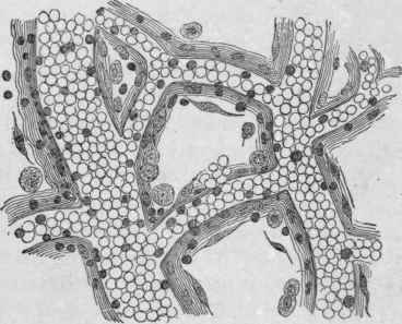 Inflammation of the Mesentery, Showing Overfilling of the Blood vessels.