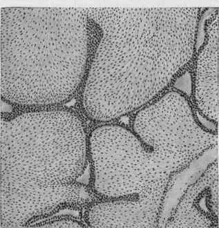 Intercanalicular adeno fibroma of mamma.