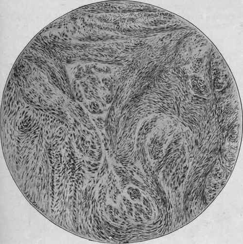Leiomyoma of the Uterus (Uterine, Fibroid). Oc. 4; ob. 3.