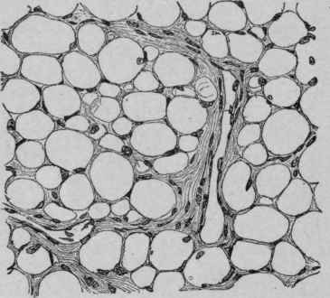Lipoma from the Region of the Shoulder with Relatively Small Fat Cells.
