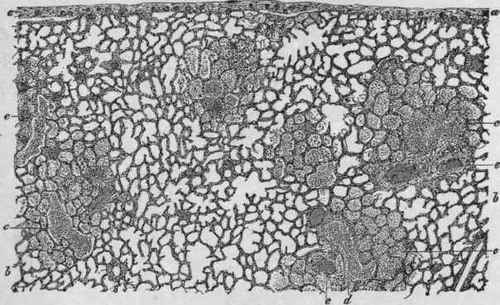 Lobular Pneumonia (Aspiration). X 8 (Ziegler).