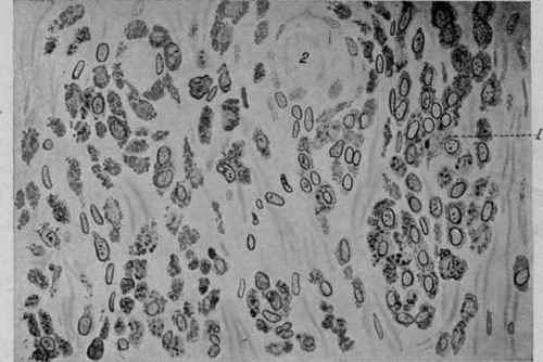 Metastatic Melanosarcoma of the Peritoneum. X 320.