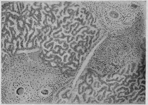 Miliary Tuberculosis of the Liver. X 70 (Dürck).