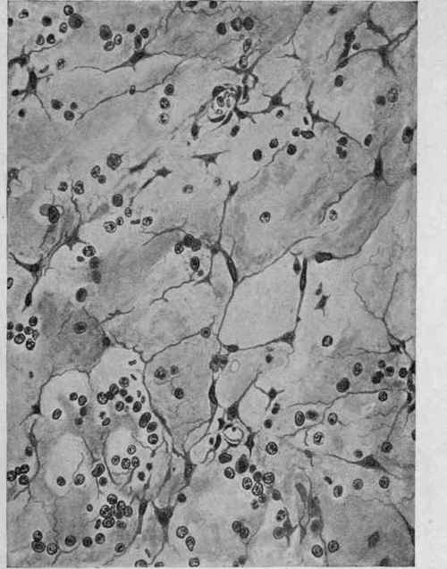 Myxomatous Fibroma of the Nasal Mucous Membrane (Dürck).