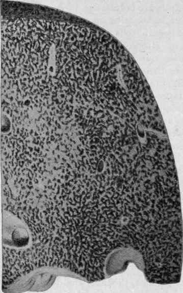 Nutmeg Liver: Chronic Congestion due to Cardiac Disease (Bollinger).