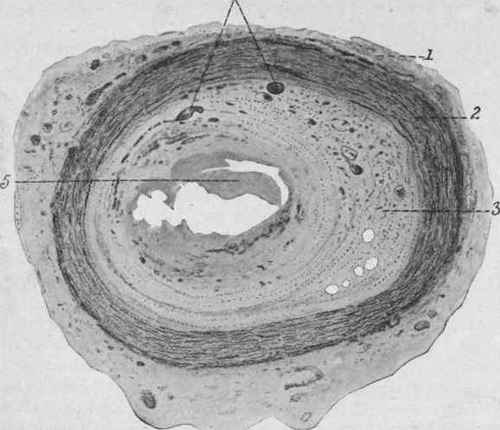 Organized and Partly Canalized Thrombus of the Brachial Artery. X 32 (Dürck).