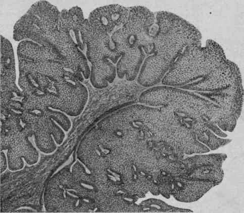 Papilloma of the Bladder. X 35 (Ziegler).