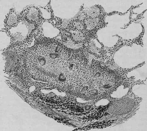 Peribronchial Tubercle of the Lung and Caseous Pneumonia of the Adjacent Alveoli (Stengel).