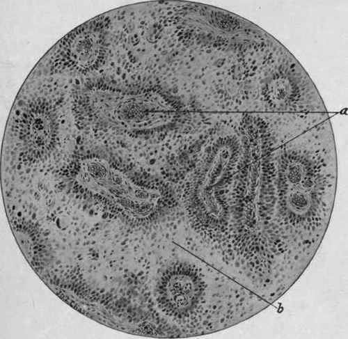 Perithelioma of the Retina (McFarland).