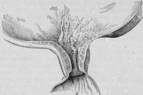 Scirrhus of the Pylorus, Causing Pyloric Stenosis (Orth).