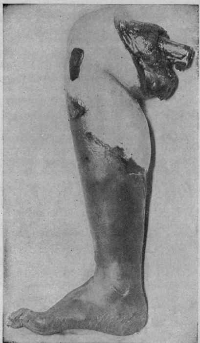 Senile Dry Gangrene of the Lower Extremity, Showing Line of Demarcation (Hektoen).