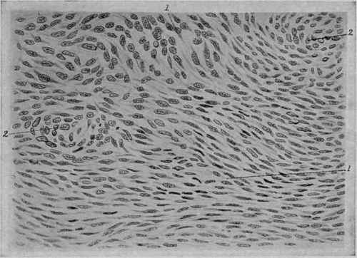Spindle cell Sarcoma from the Brain. X 300 (Durck).