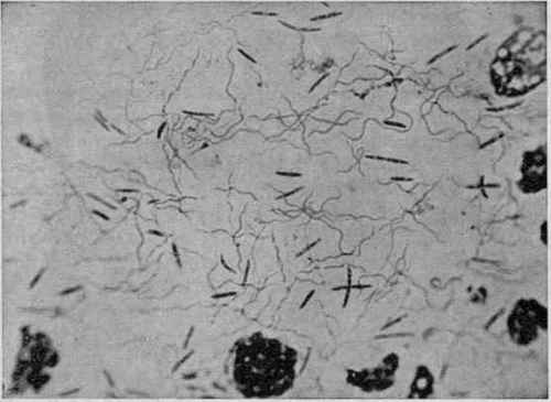 Spirocieeta Vincenti from Case of Ulcerative Stomatitis (X 1200) (Todd).