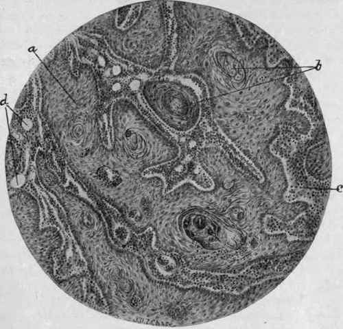 Squamous Epithelioma (McFarland).