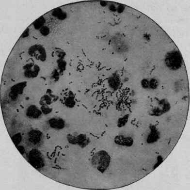 Streptococcus Pyogenes, from the Pus taken from an Abscess. X 1000 (Fränkel and Pfeiffer).