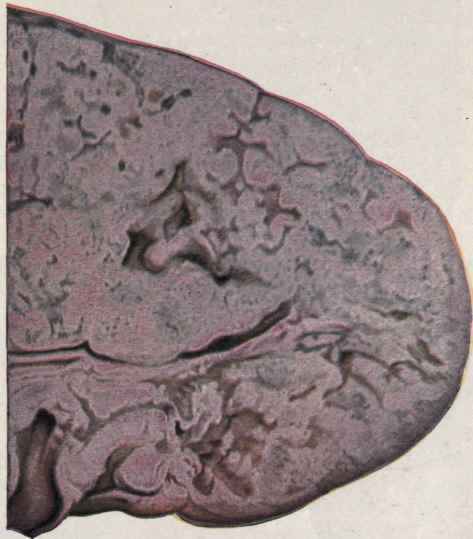 Subacute Caseous (Tuberculous) Pneumonia (Bollinger).