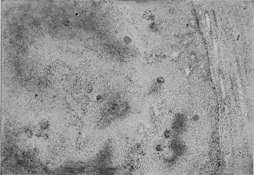 Subacute Tuberculosis of a Lymph gland. X 70 (Dürck).