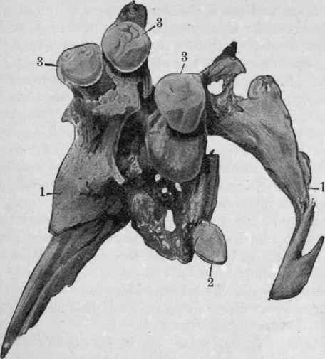 Teeth from Ovarian Dermoid (From Coplin after Roberts).