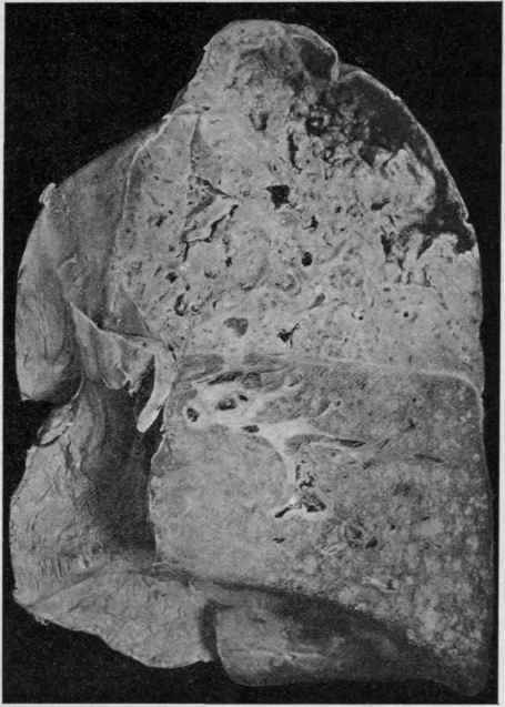 Tuberculosis of the Lung (McFarland).