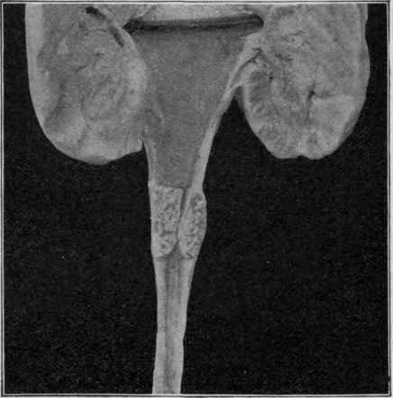 Tuberculous Nodule in the Wall of the Ureter, with Beginning Hydronephrosis.