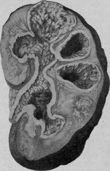 Tuberculous Pyelonephritis ( modified from Bollinger).