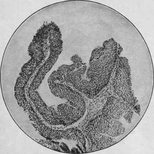 Tuft of Papilloma of the Bladder (Stengel).