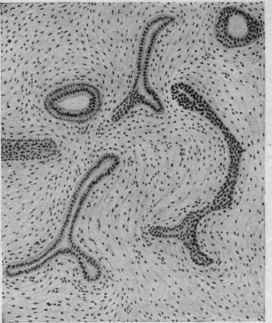 Tumors 179