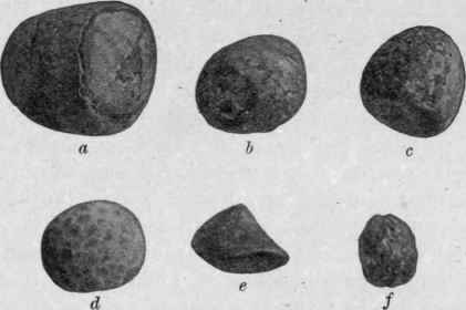 Types of Gall stones. (From a photograph in the collection of Dr. Jepson, Sioux City, la).