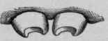 Upper Median Incisors in Hereditary Syphilis (Cornil and Ranvier).
