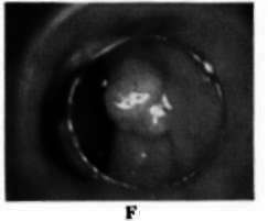 1.2 cm. adenoma with beginning pedunculation
