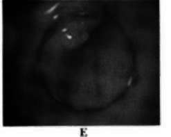 5 mm. adenoma