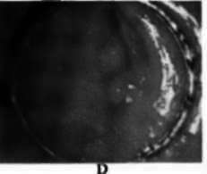 5 mm. adenoma