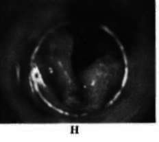 Adenocarcinoma