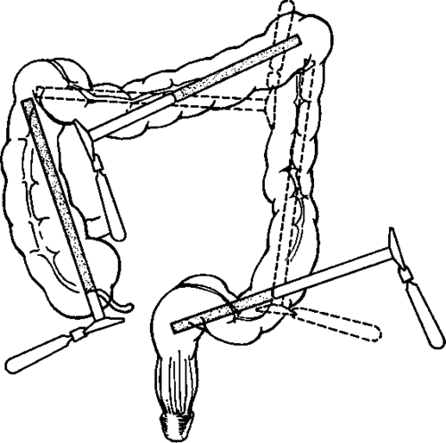 Colotomy and coloscopy