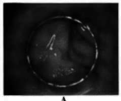 Hyperplasia