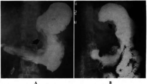 Infiltrating and ulcerating cancer involving the body of the stomach