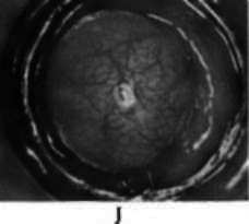 Lipoma