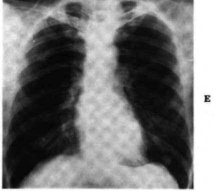 Note the 4 cm. rounded infiltration in the right lower lung field