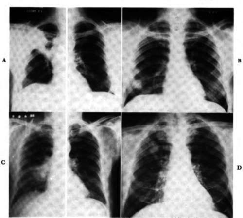 Note the increased density in the right upper lobe