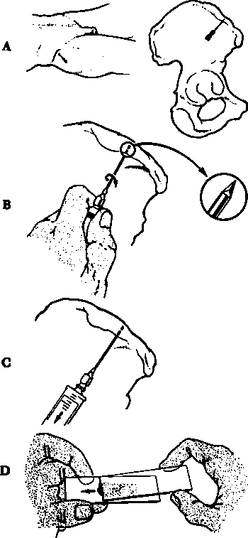 Technique of bone marrow aspiration