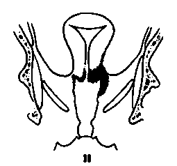The cancer extends beyond the cervix