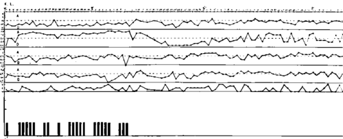 52 years old. Cancer of the hypopharynx