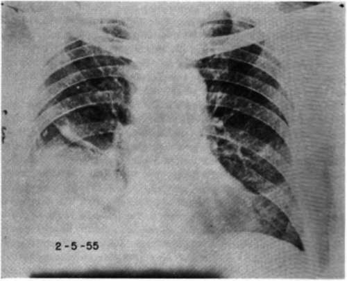 Anteroposterior view of chest in Case (A.B.) at time of admission showing the presence of a mass in the lower part of the right hemithorax
