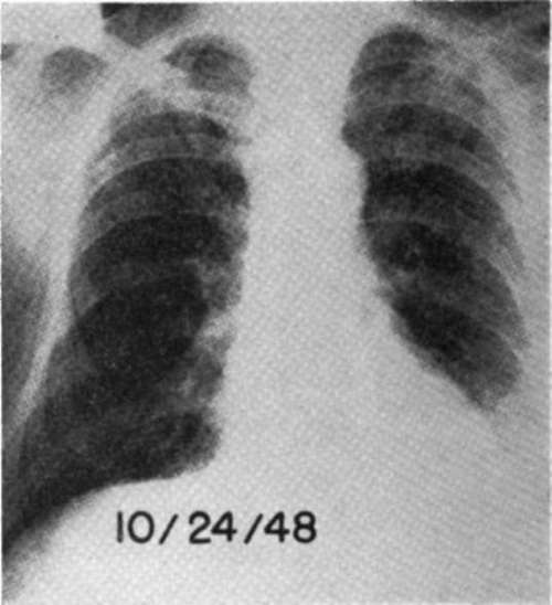 Anteroposterior view of chest in Case E.H.