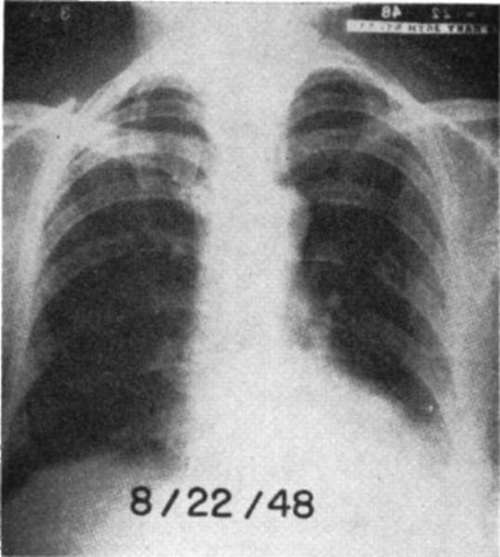 Anteroposterior view of chest in Case E.H.
