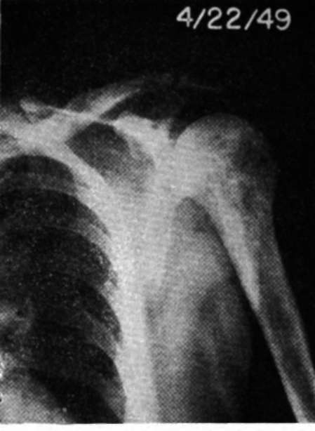 Anteroposterior view of left shoulder region in Case E.H.