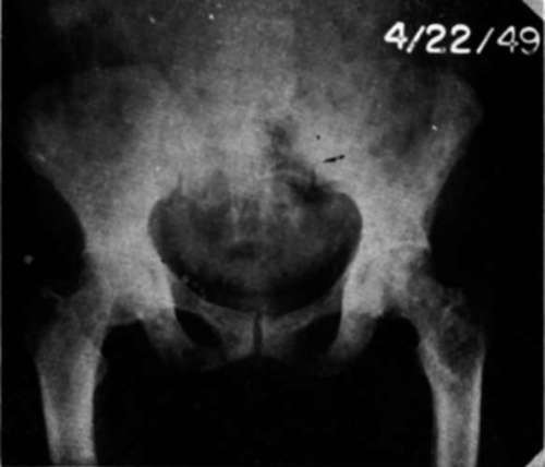 Anteroposterior view of pelvis and upper 1/3 of both femurs in Case E.H