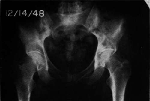 Anteroposterior view of pelvis in Case E.M.