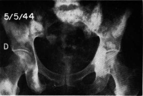 Anteroposterior view of pelvis in Case E.M.