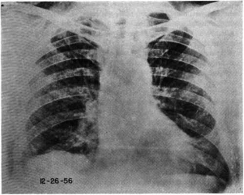 Anteroposterior view of the chest of the patient A.B. after ten months of treatment with hexyldiselenide